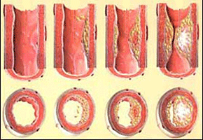 Aterosclerose, aterosclerose, poluição,